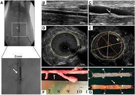 Atherosclerotic Lesions A Abdominal Aorta Balloon Denudation Model Download Scientific Diagram