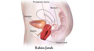 Namun begitu, wanita yang belum berkahwin juga boleh mengalaminya terutamanya dikalangan mereka yang sering melakukan aktiviti lasak atau kerja berat. Rahim Jatuh Punca Simptom Dan Rawatan The Diagnosa