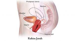 Pemberian pakan pakan merupakan komponen input yang paling besar pengaruhnya. Rahim Jatuh Punca Simptom Dan Rawatan The Diagnosa