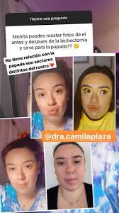 Operacion de cachetes para adelgazar la cara. El Antes Y Despues Asi Luce Christell Rodriguez Tras Someterse A Una Bichectomia Meganoticias
