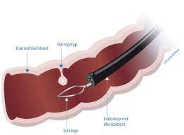 Das blut im stuhl kann dunkel oder hell sein. Koloskopie Wikipedia