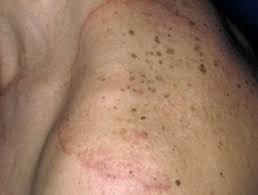 However, it may occur on any part of the body. Tinea Corporis Images Dermnet Nz