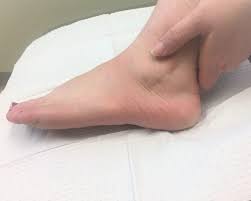 Depending on which portion that is affected, there are different classifications of achilles tendinitis. Achilles Tendon Pain Podiatry Associates Of Cincinnati