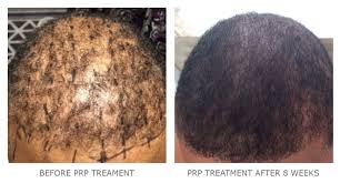 The results and evidence speak for themselves, so please feel free to come along to one of our centres and find out more. Prp For Hair Restoration Dermatologist In Bethesda Md