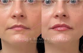 Lip Fillers Near Valrico