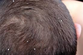 Sometimes not easy for an individual to determine what he or she has. Scalp Psoriasis Northstar Dermatology Dermatology