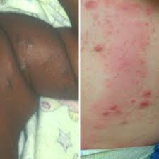 Image result for skin rash similar to scabies