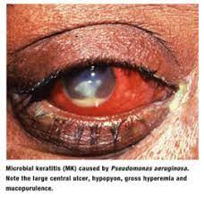 Eye Infections Part Two