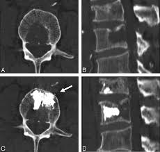 Bone Cement Deposition Patterns with Plasma-Mediated Radio-Frequency  Ablation and Cement Augmentation for Advanced Metastatic Spine Lesions