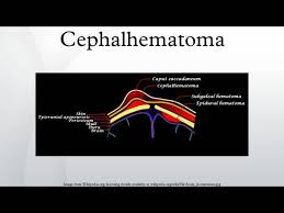 Image result for Cephalhematoma