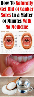 Canker Sores Are Referred To As Aphthous Ulcers And Are A Very Common Oral Issue They Might Be Situated Inside The Lips And T Canker Sore Cankers Mouth Ulcers