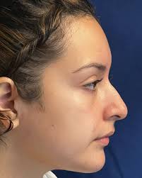 RESULTADO, Apenas 13 días después de su RINOPLASTIA. Poco hematoma, cero  dolor. Lista para regresar a su país ,EEUU.