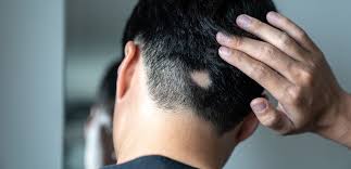 30 giovani uomini su 100 soffrono di perdita di capelli precoce e questo è dovuto a cause genetiche ed ereditarie. Diradamento Capelli Cause E Possibili Rimedi Santagostino Magazine