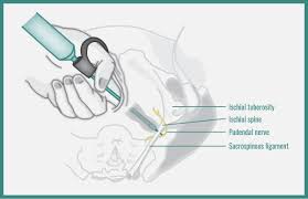Image result for Pudendal Block