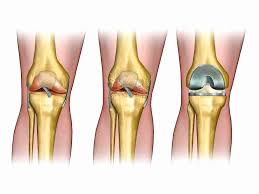 Dans l'arthrose de la hanche (coxarthrose), les résultats sont. Solutions Naturelles Contre L Arthrose Mains Hanches Etc