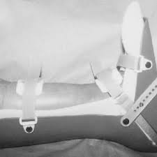 Image result for Posterior Night Splint