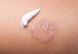 Jock itch is an infection in the groin area that can occur in both females and males but it is more common in males. How To Cure Ringworm Health Essentials From Cleveland Clinic