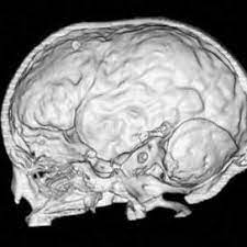 From wikipedia, the free encyclopedia copper beaten skull is a phenomenon wherein intense intracranial pressure disfigures the internal surface of the skull. Pdf The Copper Beaten Skull