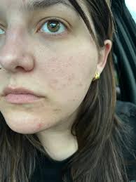 Is La Roche Posay suitable for mature skin with fine lines and puffy eyes?