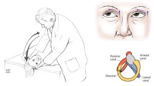Image result for Canalith Repositioning Procedure