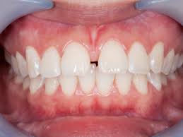 Image result for dental cancer