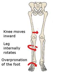There Is Growing Evidence That Weak Hips Contribute To A Number Of Problems Lower Down The Leg Including Hip Flexor Stretch Overpronation Scoliosis Exercises