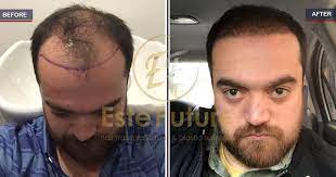 The Result Of 5 Months 3700 Grafts After Fue Hairtransplant With Este Future In Turk Fue Hair Transplant Hair Transplant Before And After Hair Transplant