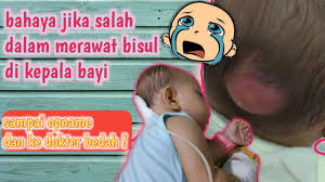 Bisul adalah benjolan berisi nanah yang disebabkan infeksi bakteri. Bisul Pada Anak Penyebab Dan Cara Mengobatinya Sekolah Prestasi Global