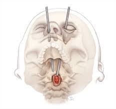 First-of-Its-Kind Surgery Uses Eye Socket to Remove Spinal Cancer |  www.PhysiciansWeekly.com