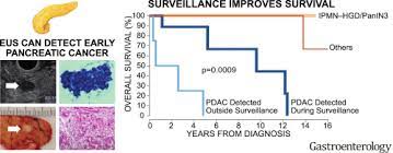 Now, pancreatic cancer is not caused by gall stones or alcohol. Risk Of Neoplastic Progression In Individuals At High Risk For Pancreatic Cancer Undergoing Long Term Surveillance Gastroenterology
