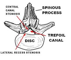Hernie de disc l4 l5? StenozÄ SpinalÄ Wikipedia
