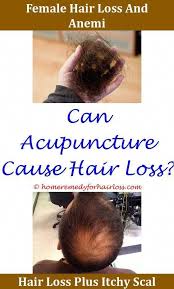 Pin On Hairlossblog