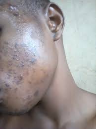 How to get rid of black spots on neck. How Do I Get Rid Of Dark Spots On My Face Health Nigeria