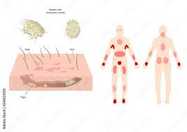 Image result for Sarcoptes scabiei