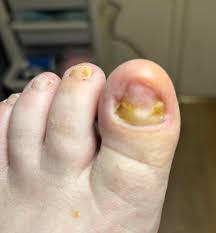 Image result for Onycholysis feet