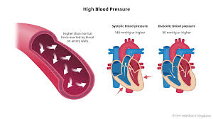 Image result for Hypertension