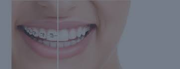 Las carillas son la solución ideal si buscas tener la sonrisa perfecta. Ortodoncia Tu Clinica Dental En Mostoles Y En Galvez Toledo
