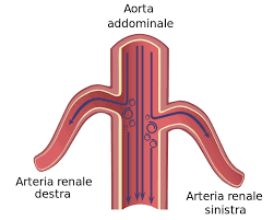 Aneurisma cerebrale ed emorragia subaracnoidea. File Turbolenze Aneurisma Aorta Addominale Svg Wikipedia