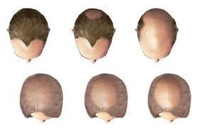 Hair loss treatments in 2021: Total Hair Loss Solutions In Leeds Read 8 Reviews