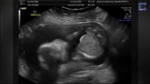 Baby Punches Himself In Face In Viral Ultrasound 6abc Philadelphia