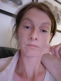 Can I have this very hyperelastic skin whiteout having ehlers danlos?