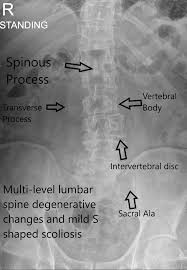 Case Study Selective Nerve Root Block In A 70 Year Old Female With Radiculopathy