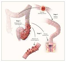 Image result for Diverticulitis