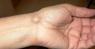 Resultado de imagen de quiste