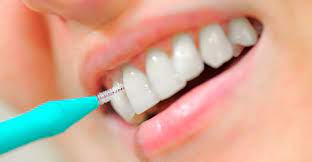 Limpiar Entre Los Dientes Clinica Dental Bapident