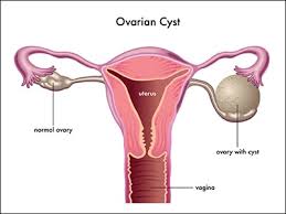 ayurvedic treatment of ovarian cysts herbal remedies