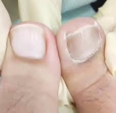 Sebagai lelaki, ahmad pun tak bisa bohong bahwa ummahat di hadapannya masih terlihat menarik walau telah memiliki beberapa orang anak. Masalah Kuku Kaki Hitam Punca Dan Penyelesaian Curio Spa