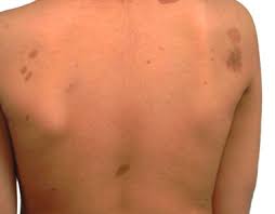 2 or more of thefollowingpointsarepresent. Wie Erkenne Ich Neurofibromatose