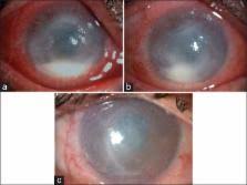 This rare but severe form often mimics severe microbial ulcers and can result in corneal perforation. Clinical Efficacy Of Oral And Topical Acyclovir In Herpes Simplex Virus Stromal Necrotizing Keratitis Scienceopen