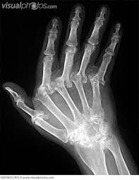 Scans that may be done to diagnose and monitor rheumatoid arthritis include: Arthritis Xray Images For Website Hand X Ray Of The Hand Of A Patient With Severe Rheumatoid Arthritis X Ray Severe Rheumatoid Arthritis Radiology